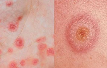 Erythema multiforme is a rare skin reaction triggered by medication, an infection – such as the herpes simplex virus – or an illness