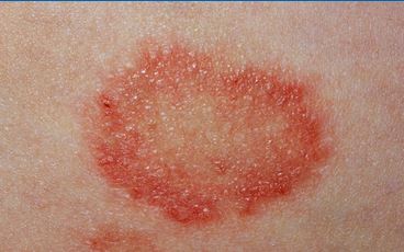 Most cases of ringworm are mild and it can be treated easily with an over-the-counter cream from your pharmacist