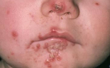 A rash with blisters that burst to leave a thick yellow-brown golden crusts around the nose and mouth is a sign your baby is suffering impetigo