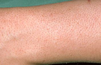 Keratosis pilaris makes the skin look as though it is permanently covered in goose pimples 