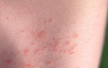 Tiny spots or bumps surrounded by an area of red skin is a sign your baby is suffering prickly heat