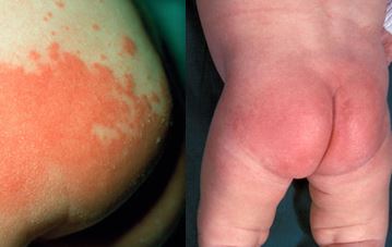 Nappy rash is typically red, painful and blotchy and should clear up within a few days