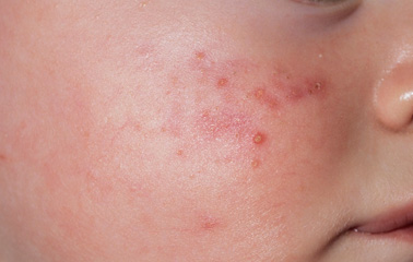 It is normal for babies to get rashes, but how can you tell the serious ones from milder conditions like baby acne, pictured