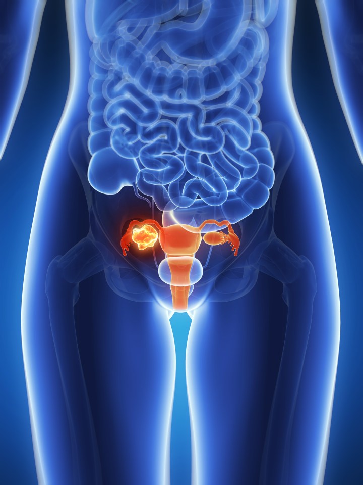 New research has revealed almost half of women diagnosed with deadly ovarian cancer see their GP three times before being diagnosed