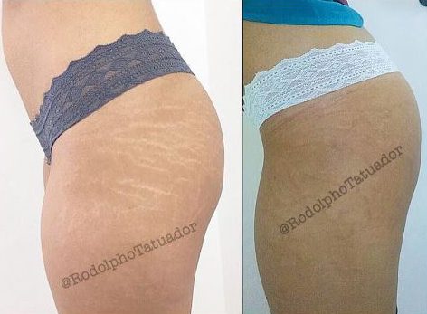  Before the treatment this woman's stretch marks are clearly visible on her thigh and buttocks but the tattooing makes them almost completely disappear