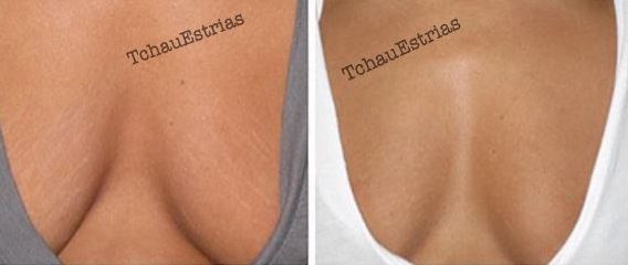  The stretch marks on this woman's chest are reduced following the tattoo