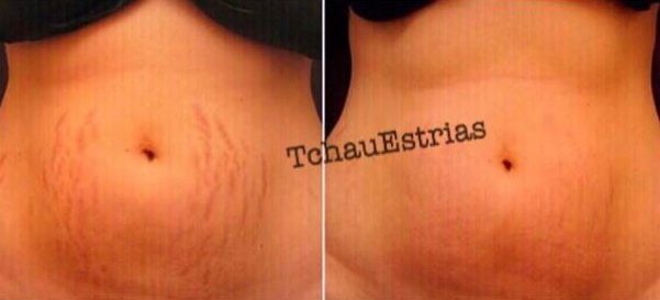  Tattoos on this woman's stomach helped the appearance of her stretch marks