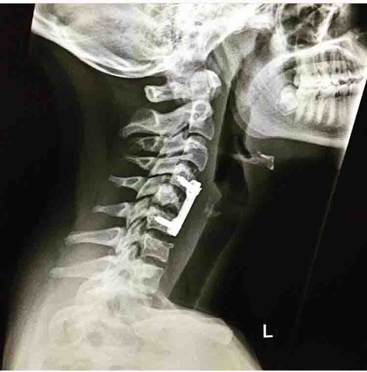 X-ray of Kelsey's neck which was broken in four places