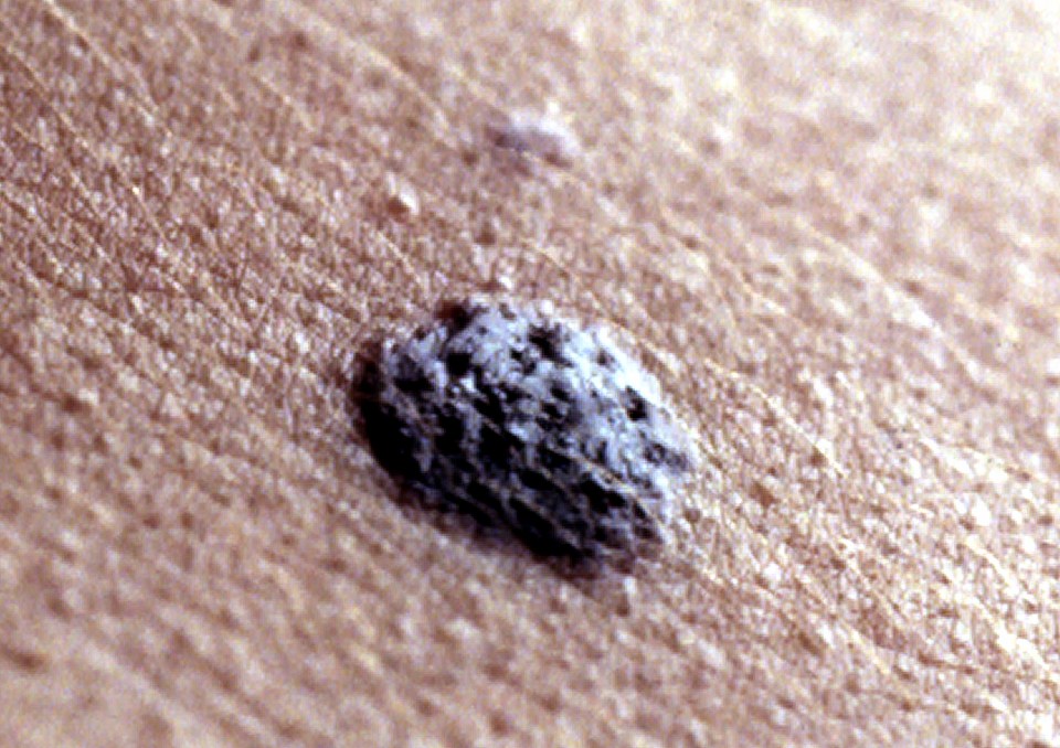  In 2013, there were around 14,500 new cases of malignant melanoma in the UK – around 40 every day