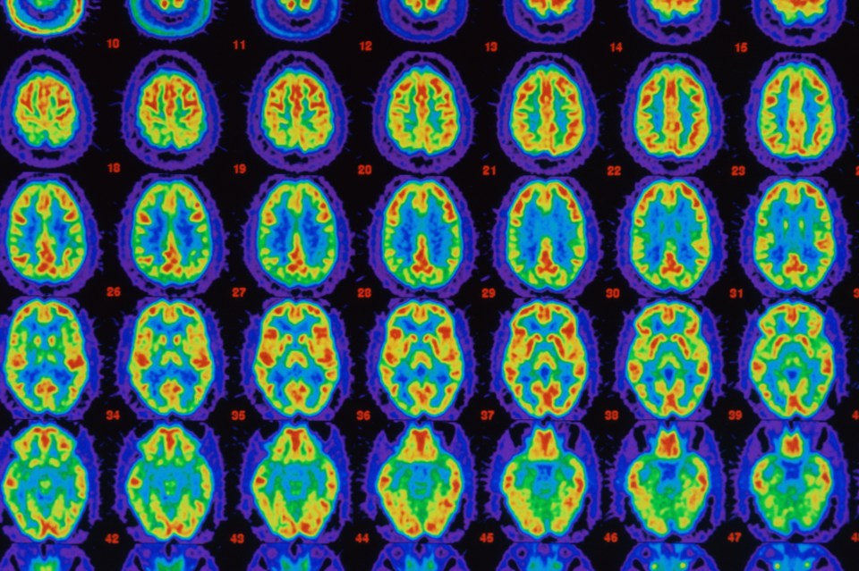 Strobe lighting halts the build-up of amyloid plaques in the brain, which are a key marker of the most common form of dementia