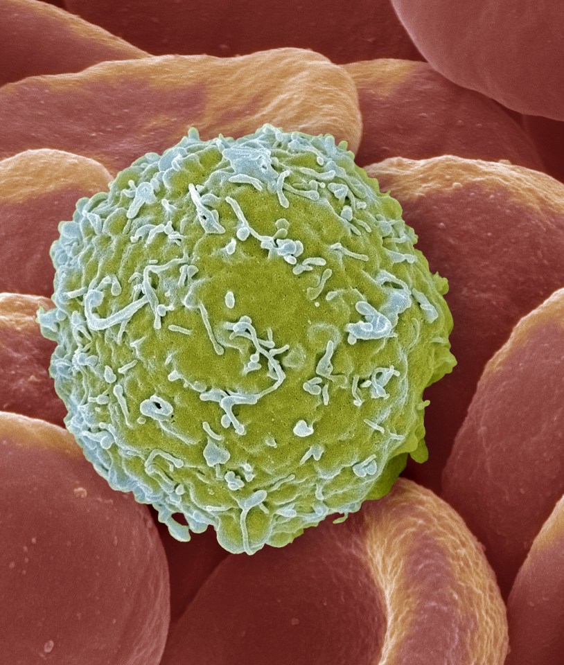  Leukaemia is a type of blood cancer of cells in the bone marrow and attacks part of the immune system