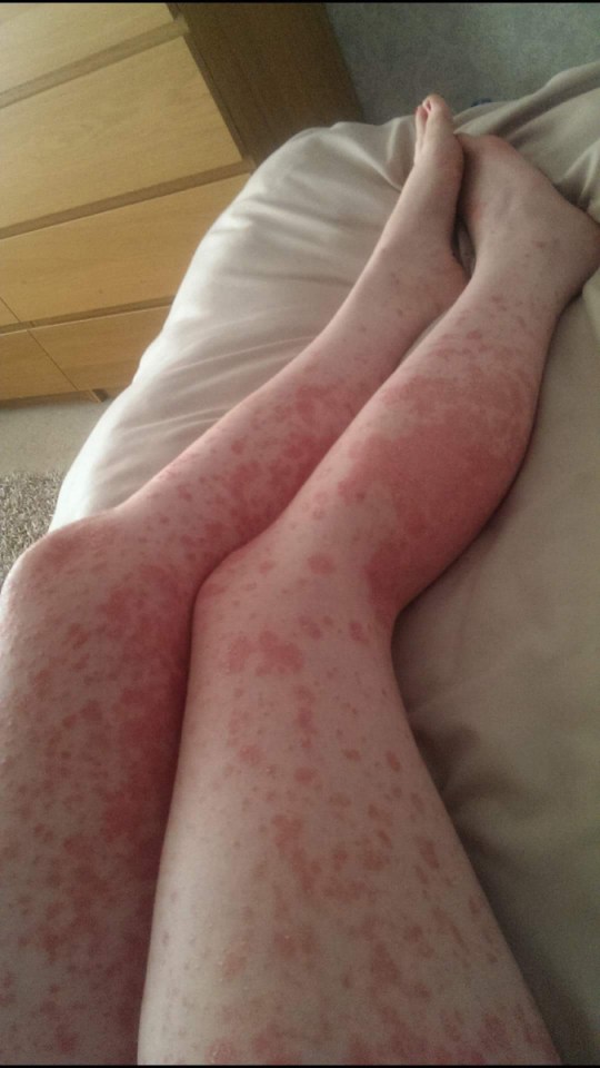 In December 2014 a major attack of psoriasis saw the flaky, scales spreading across her body, leaving it bleeding at the slightest touch