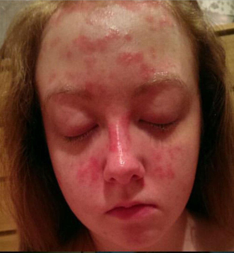 When her skin is at its worst the bleeding scales are so painful, Elizabeth, now 18, can't walk or sleep