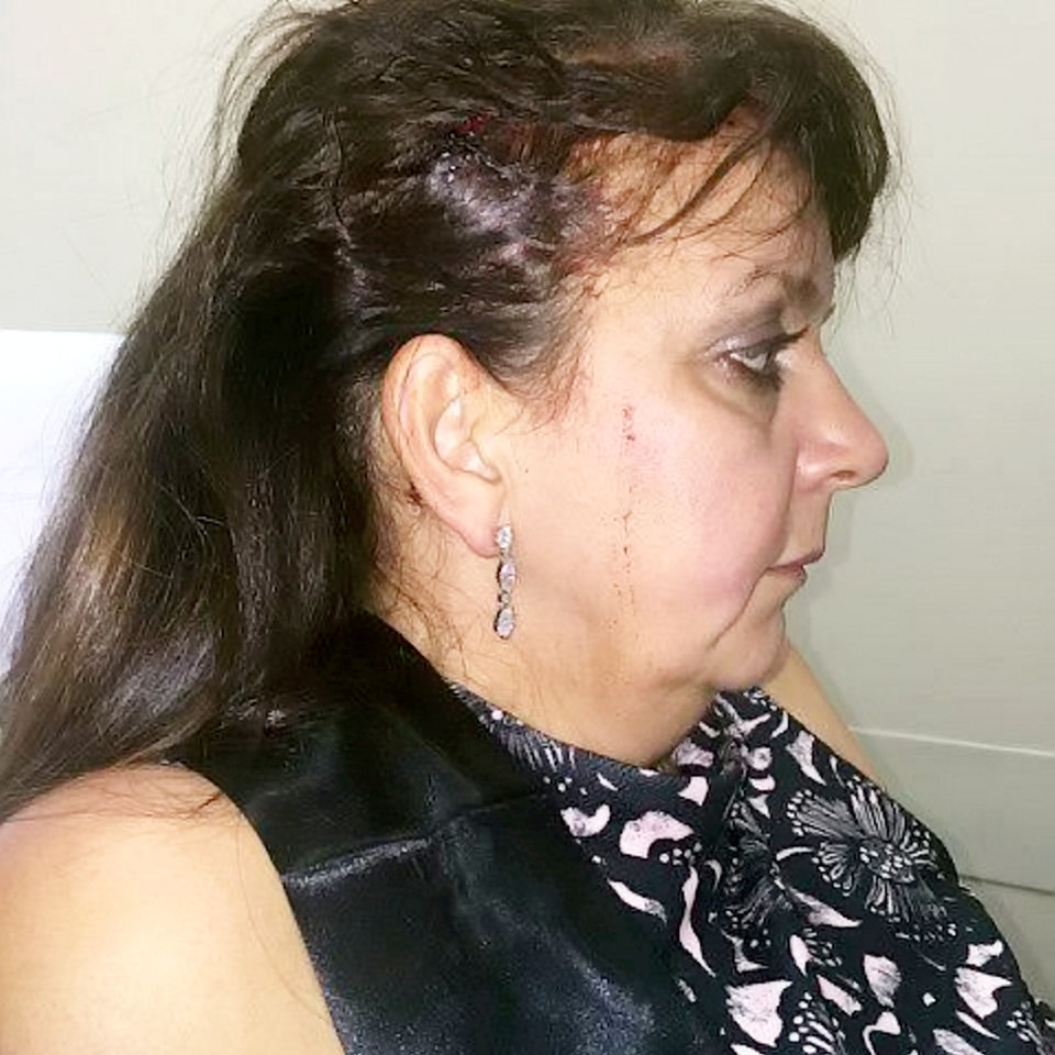  Lisa had been celebrating her daughter's upcoming wedding when the bottle was hurled at her head by a reveller