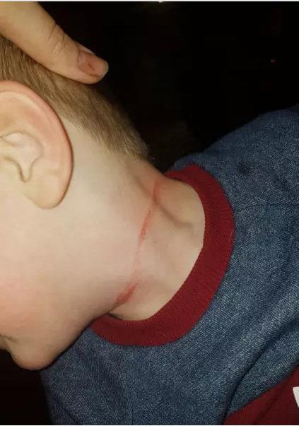  Jimmy Cane suffered cuts and rope burn around his neck after a stray rope from the play area wrapped around his neck