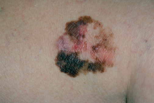 Melanoma can appear anywhere on the body, but is most common on the back, legs, arms and face