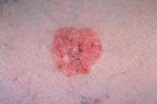 Squamous cell carcinoma are mainly found on the face, neck, bald scalps, arms, backs of hands and lower legs