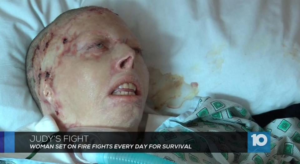  Judy Malinowski was left with horrific burns after her lover set her on fire at a petrol station