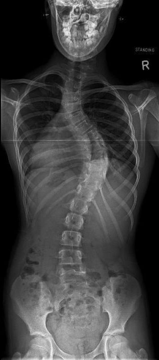 An X-ray of Macy's back clearly shows the abnormal curve in her spine