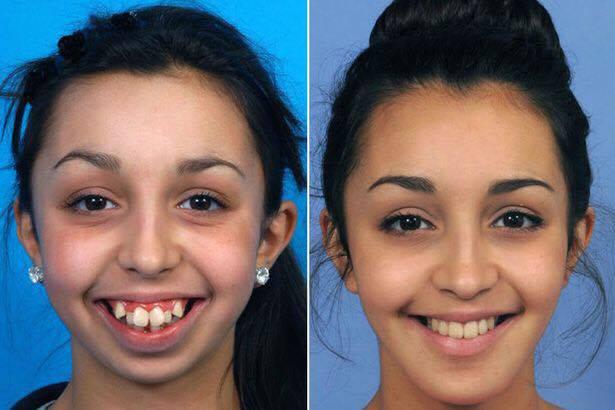  Ellie Jones seen before and after she had surgery on her jaw