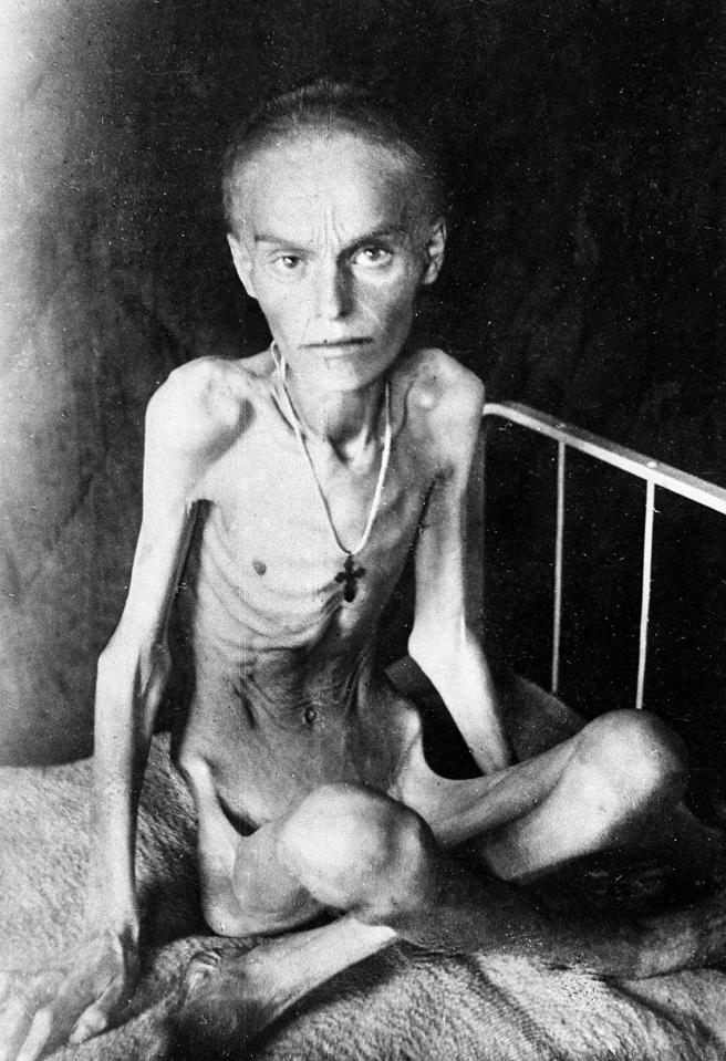  A malnourished nine-year-old girl pictured during the famine