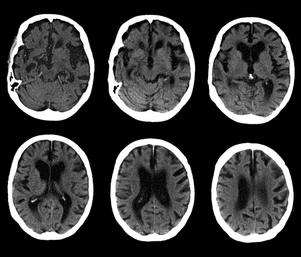 A lack of vitamin A increases the production of amyloid beta, the protein that kills brain cells in Alzheimer's