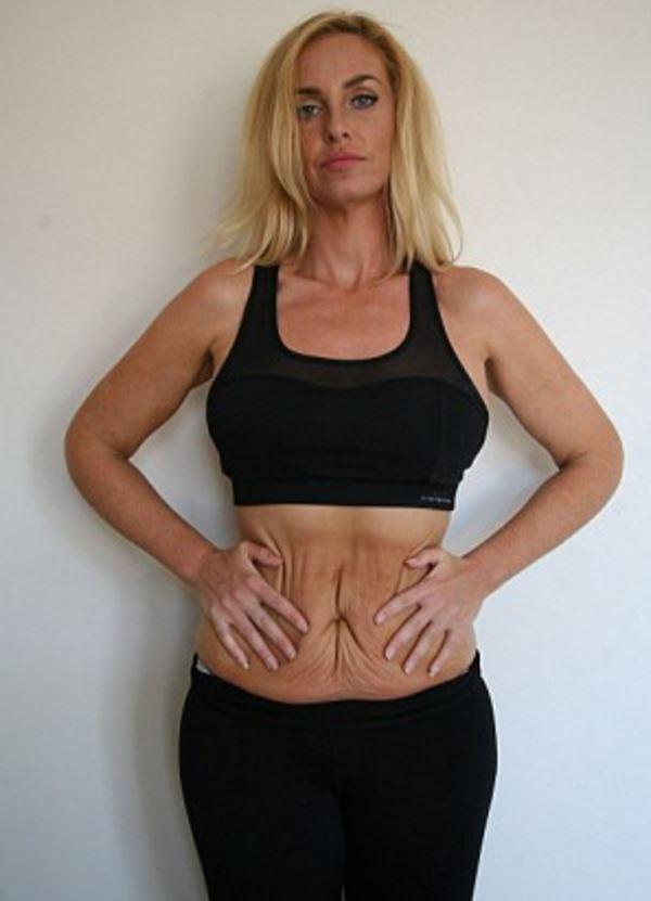  Josie Gibson has undergone surgery to remove excess skin around her stomach