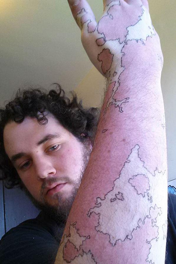  A curly-haired man doodled around the red blotches on his arm so it now looks like a giant world map