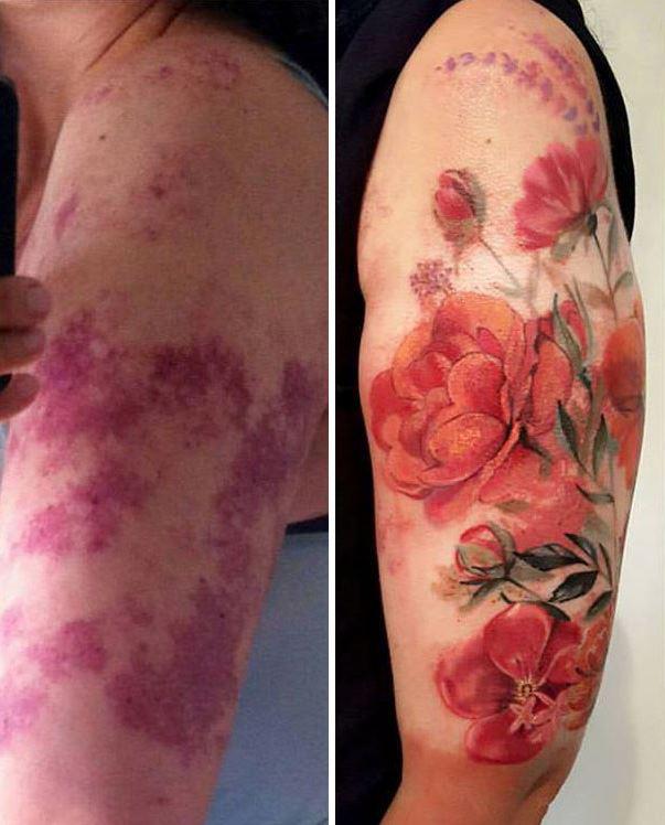  A woman has had a stunning orange floral design incorporated over the red blotches on her arm