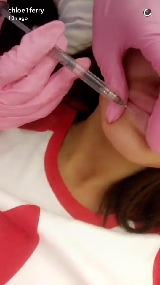 Earlier this week Chloe shared a video on Snapchat while getting her regular nose of lip filler 