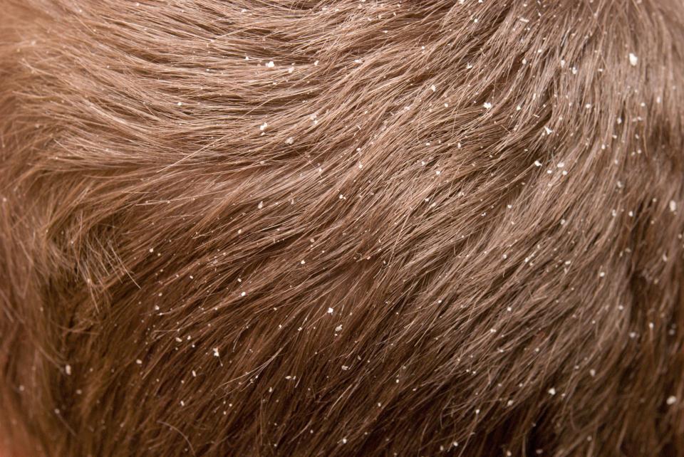 Dandruff is a common condition that causes the skin on the scalp to flake