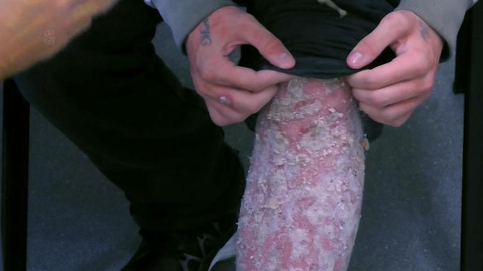  The condition is so bad that the skin on his leg has been reduced to powder