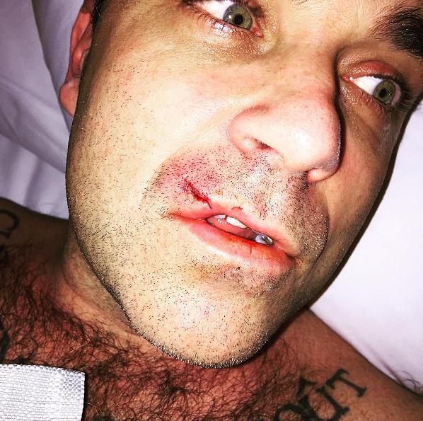  Robbie's wife Ayda Field posted a painful-looking photo on social media following the incident