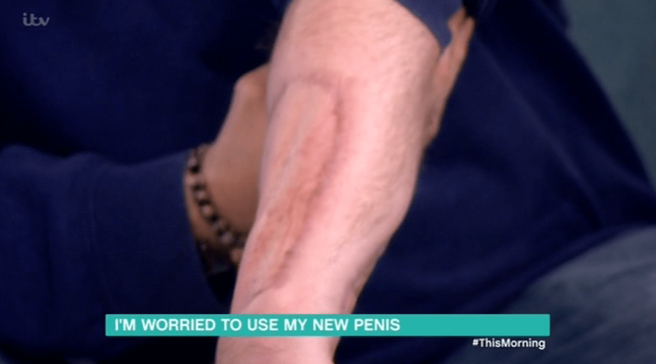  Andrew had a skin graft taken from his arm to make his penis