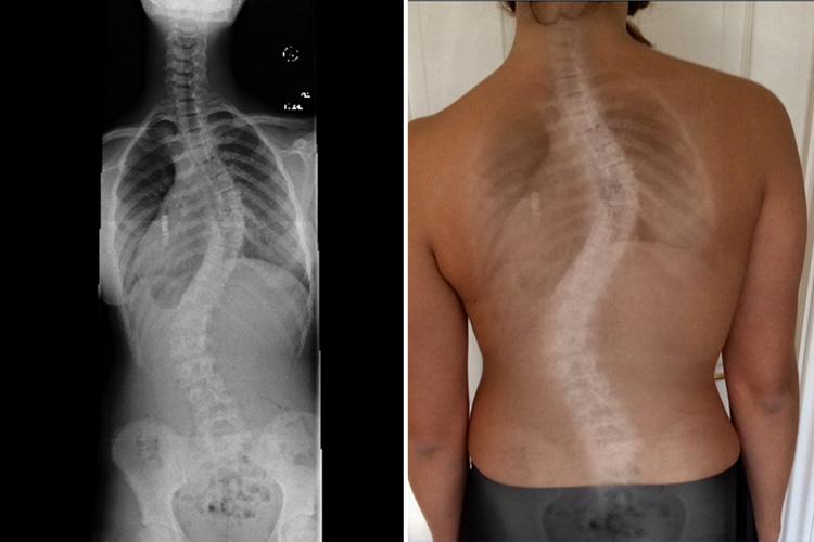 A teenage suffering a rare double scoliosis of the spine is raising money for life-changing surgery that's no longer available on the NHS