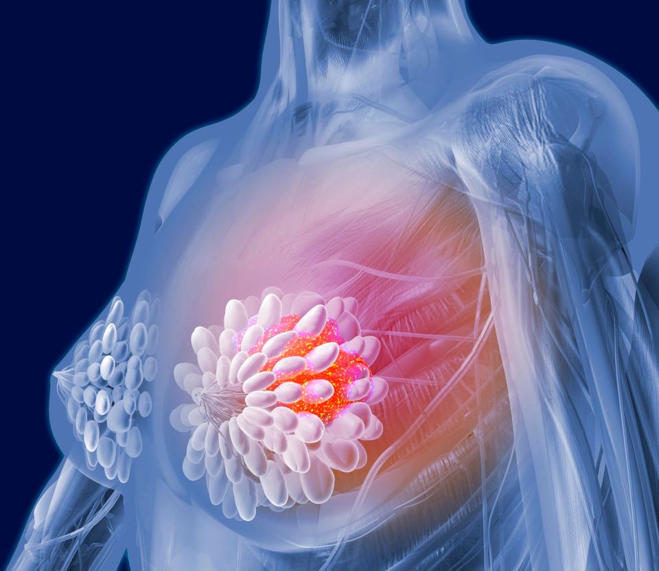  One in eight women in the UK will be diagnosed with breast cancer in their lifetime, according to Cancer Research UK