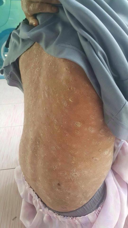 Usually psoriasis only affects small patches on the body but in extreme cases, like Ranee's, flaky skin appears all over the body