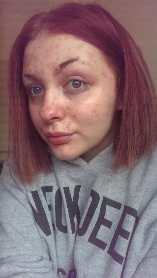  Sophia Ridlington, 22, was diagnosed with psoriasis – a skin condition that causes red, flaky, crusty patches of skin covered with silvery scales, in her late teens