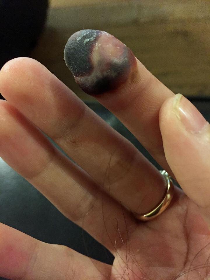  Ellie's index finger started to turn black and she was warned loss of limbs was common