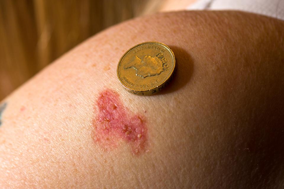  BCC can look like a scaly, red patch on the skin and there can be a brown pigment within the patch