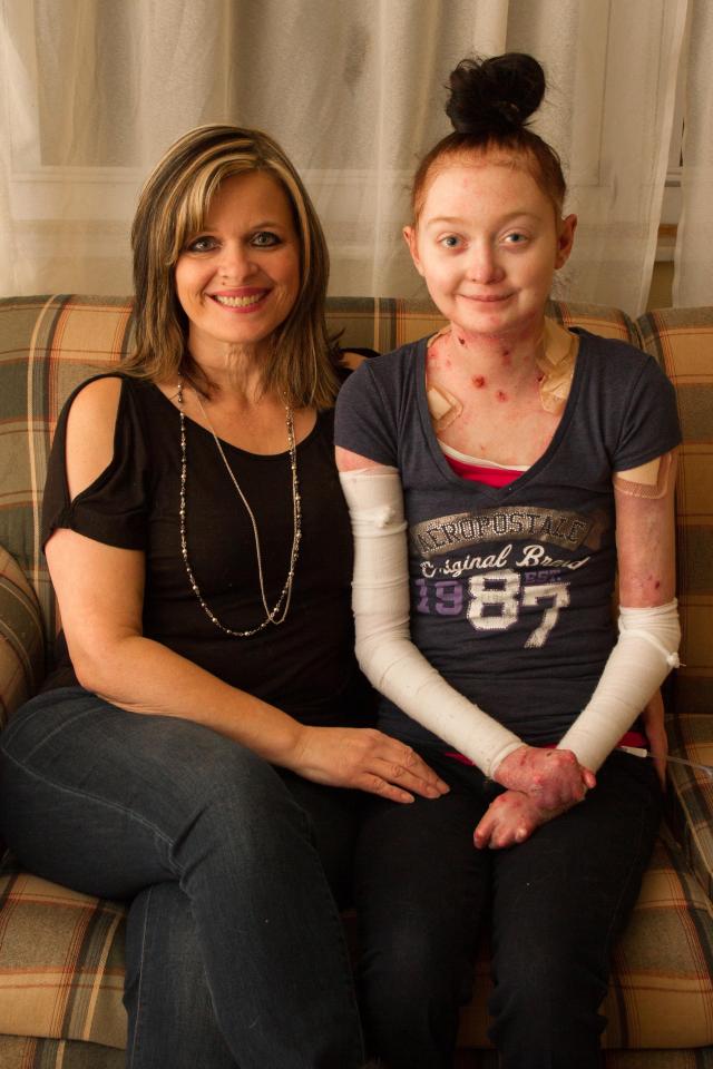 Her mum, Mary, has to help her bath to prevent infection in her skin