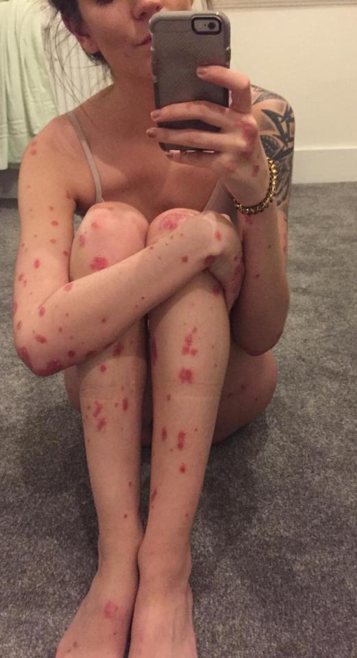 Beth puts her skin condition, psoriasis, down to exam stress at uni