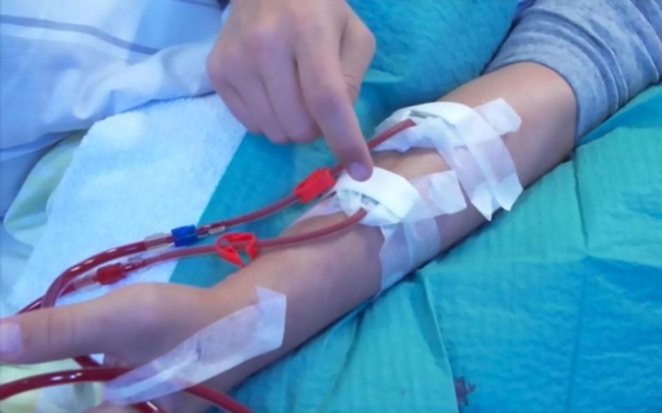  Ivan Klasnic shows off the needles connected to his arm to perform dialysis