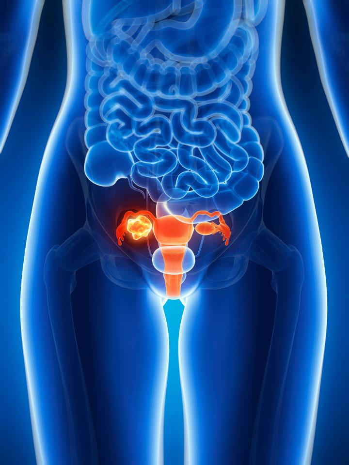 Women who take the pill have a 34 per cent less chance of developing ovarian cancer