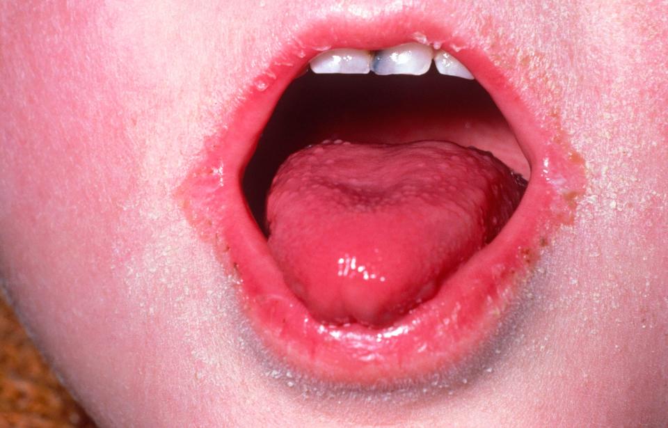  A red rash and dryness on the tongue are among the symptoms of scarlet fever