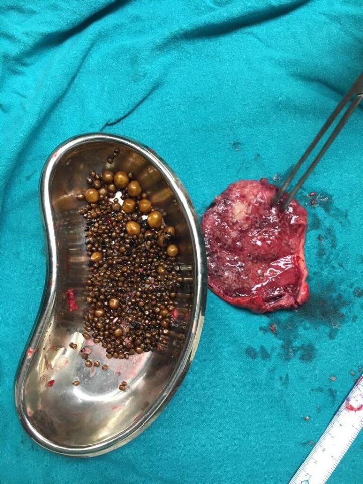 The sheer number of gallstones is visible when they are emptied into this dish 