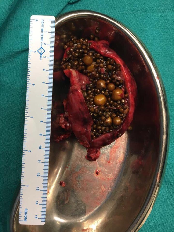 An extraordinary amount of gallstones were found during the surgery - the ruler gives a sense of scale 