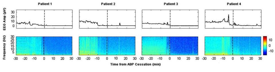 The scans show brain activity ceasing before the heart stopped beating, except for in patient four