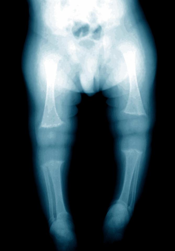  The X-ray of a young child with rickets - as we hear the news that cases are on the rise in Britain