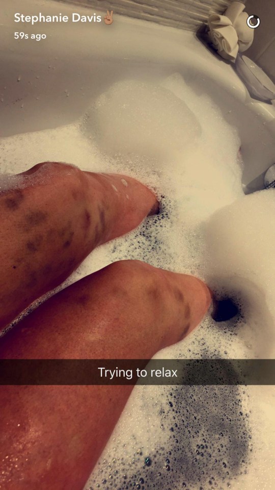 Stephanie Davis showed off some mysterious marks on her legs during her bath